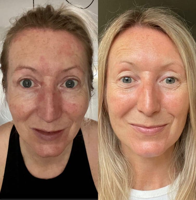 Before and after of a woman's face showing a lifted, firmer result after the fascial facelift protocol