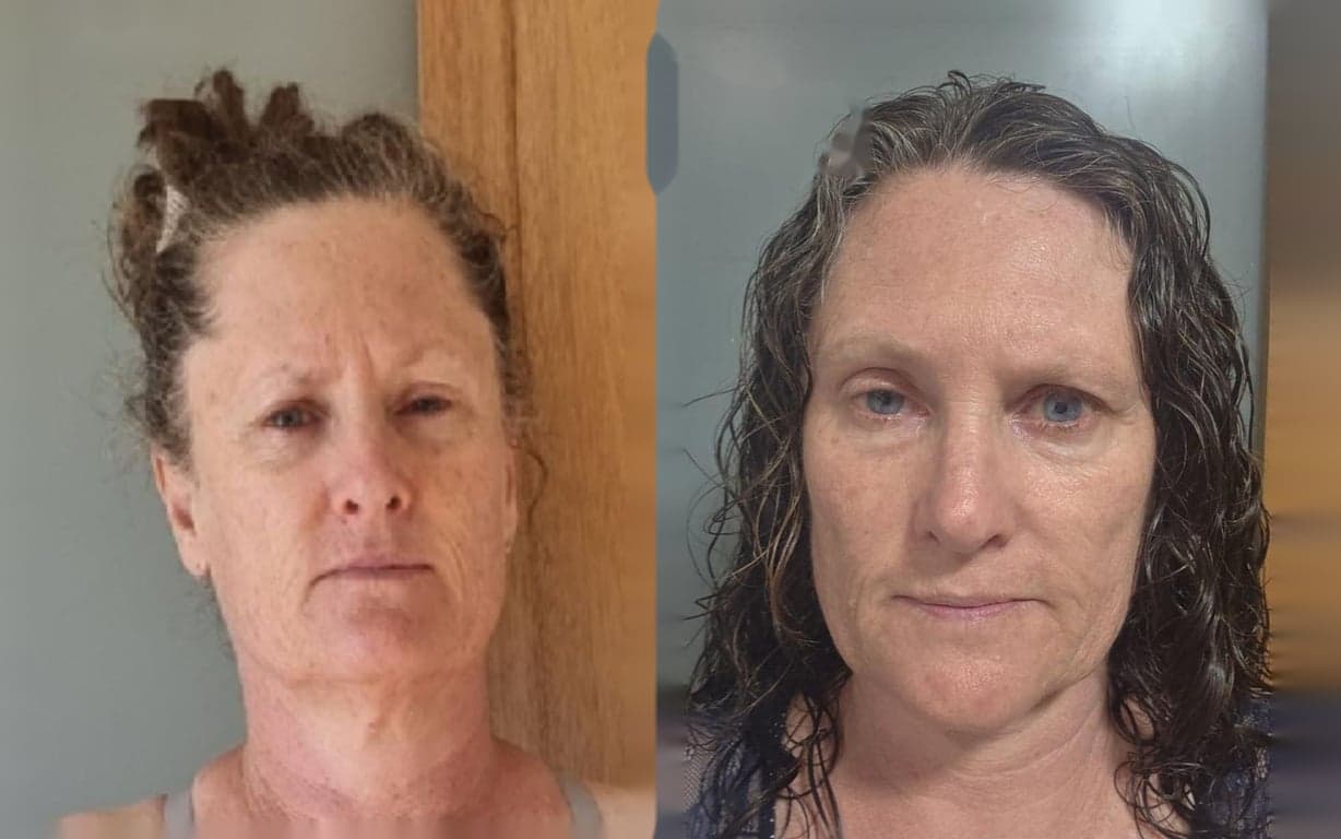 Before and after showing softer lines and restored facial symmetry from the fascial facelift protocol
