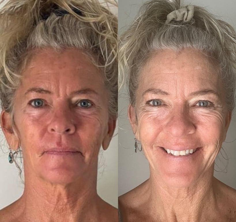 Before and after showing brighter skin tone and reduced facial puffiness following the fascial facelift protocol